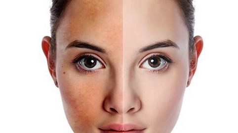 Tạm biệt làn da đen sạm đơn giản ngay tại nhà