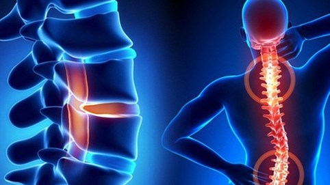 Bác sĩ nói gì về thói quen vặn lưng mỗi khi bị mỏi và nghe tiếng răng rắc rất vui tai?