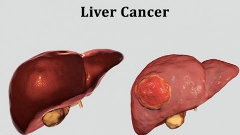 5 yếu tố lớn nhất có nhiều khả năng gây ung thư gan: Dù bạn ở lứa tuổi nào cũng nên tránh