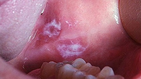 Sống ở các thành phố đầy khói bụi làm tăng nguy cơ ung thư miệng lên tới 40%