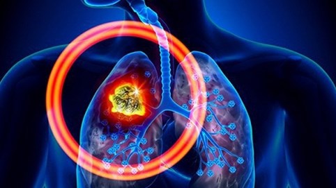 Sụt 4 kg trong 1 tháng, đi khám phát hiện ung thư phổi giai đoạn cuối