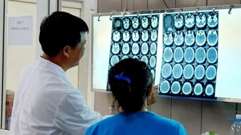 Ca đầu tiên ở Việt Nam bị xuất huyết não khi dùng ma túy đá