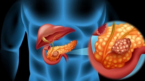 Viêm tụy cấp nguy hiểm thế nào?