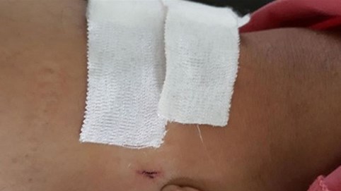 Nóng 24h qua: Diễn biến mới vụ nam thanh niên bị bệnh viện khoan nhầm cẳng chân