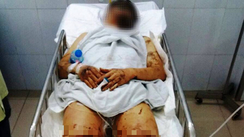 Nhận dạng nghi phạm tạt axit, cắt đứt gân chân nam Việt kiều: Người gầy, nói giọng Bắc
