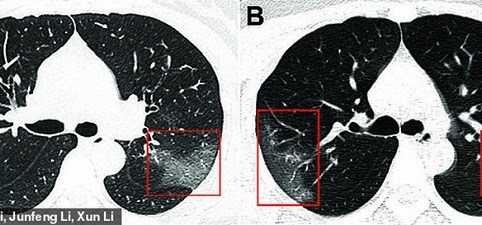 Thấy gì trong ảnh phổi của một bệnh nhân nhiễm virus Corona?