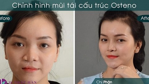 Người sứt môi, hở hàm ếch sẽ có cơ hội được phẫu thuật miễn phí