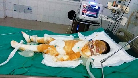 Xót xa cảnh bé gái 4 tuổi bị bỏng nặng nằm đau đớn trên giường bệnh
