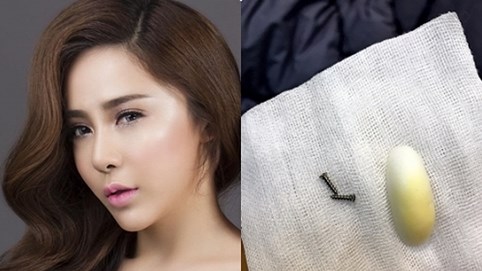 Á khôi doanh nhân Mai Diệu Linh “tá hỏa” khi phát hiện 2 chiếc đinh vít trong cằm