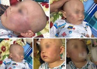 Bảo mẫu tát bé trai 19 tháng tuổi sưng mặt