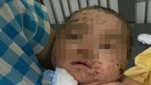 Bé trai 4 tháng tuổi bị nhiễm độc da toàn thân vì tắm lá thuốc Nam