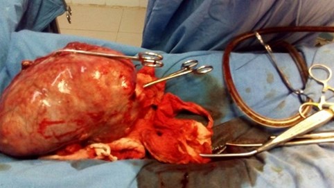 Quảng Nam: Phẫu thuật thành công bệnh nhân có khối u 4kg