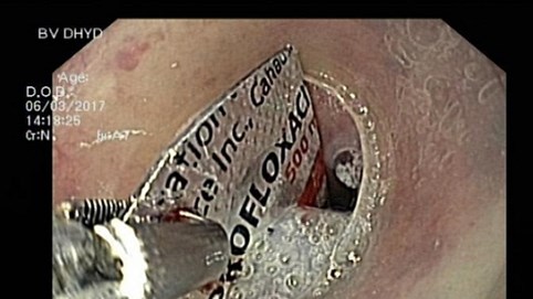 Nhập viện do nuốt phải bao phim thuốc