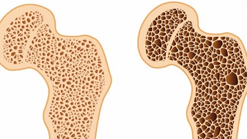 Bảo vệ xương để chống suy giảm khả năng sinh dục