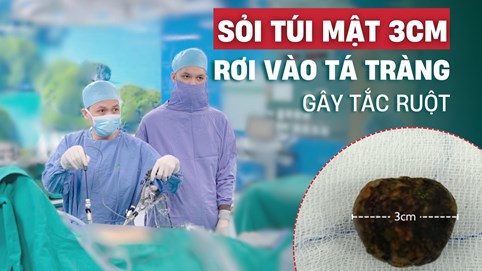 Hi hữu: Sỏi mật 3cm rơi từ túi mật vào tá tràng gây tắc ruột