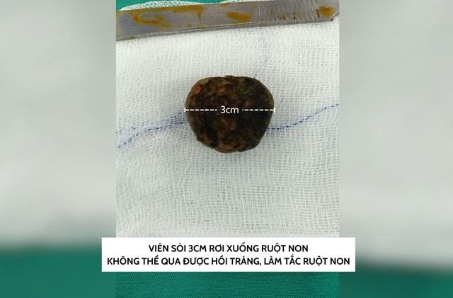 Vi&ecirc;n sỏi 3cm rơi thẳng từ ruột non xuống t&aacute; tr&agrave;ng.